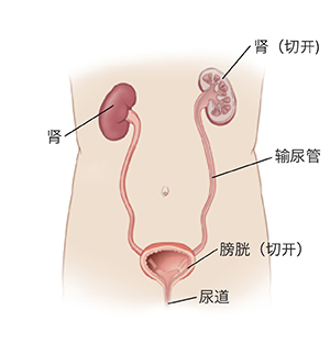 顯示腎臟、輸尿管和膀胱的身體前視圖。顯示膀胱和一側腎臟的剖面圖。