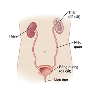 Hình chiếu trước của cơ thể cho thấy thận, niệu quản và bàng quang. Bàng quang và một quả thận được hiển thị ở mặt cắt ngang.
