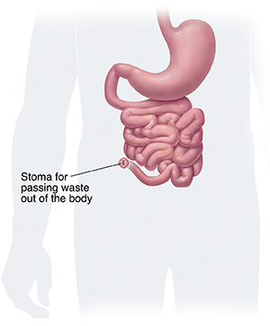 Front view of lower digestive tract with colon and rectum removed, showing stoma for permanent ileostomy.
